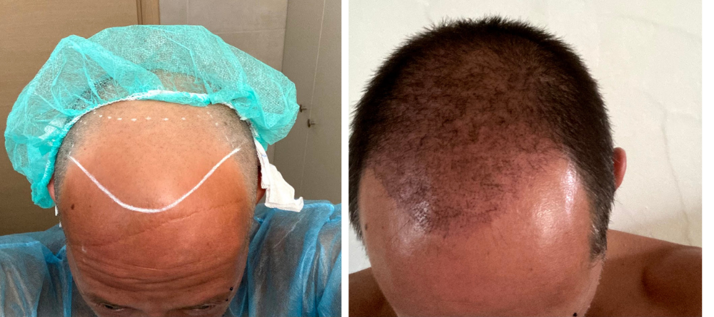 Monsieur Cheveux, le sp&eacute;cialiste de la greffe de cheveux en Gr&egrave;ce